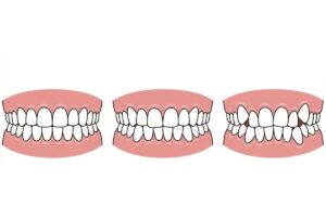 前歯の並びのイメージ